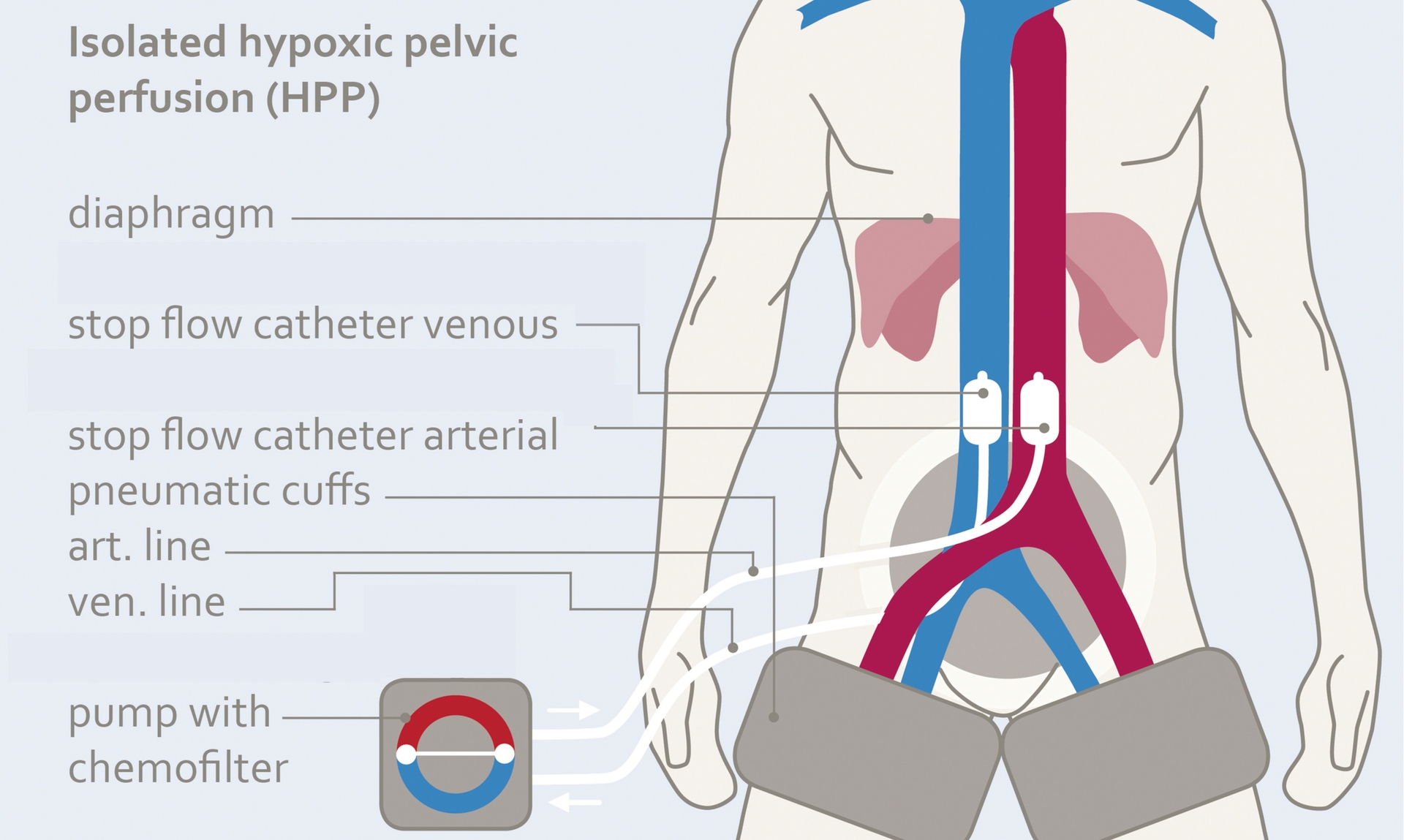 New Combination Therapy for Anal Cancer: Isolated Hypoxic Pelvic Perfusion with Electroporation Leads to Complete Remission in All Treated Patients image