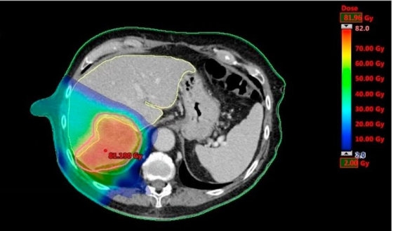 Proton Therapy for Liver Cancer Treatment  image