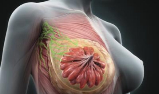 Breast Cancer Guide image