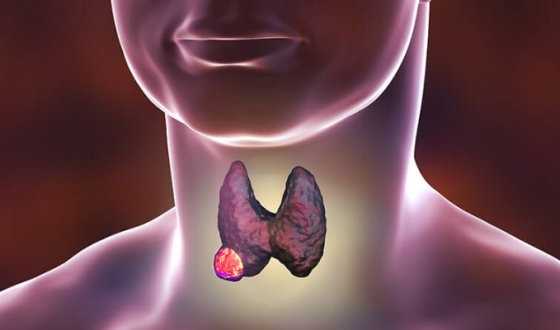 Thyroid Cancer Guide image