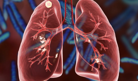 Lung Cancer Guide