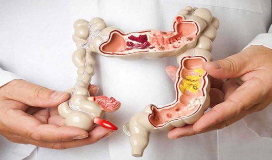Intestinal Cancer Guide image