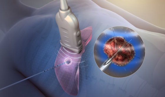 Ablation Therapy for Liver Cancer image