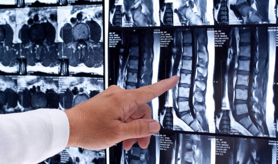 Effective Treatment for Spinal Cord Injuries image