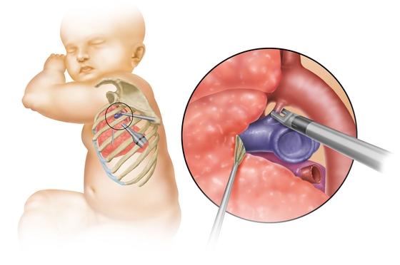 Pda Suregery Micro-Invasive Heart Surgery for Patent Ductus Arteriosus (PDA ...